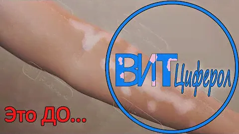 Лечение витилиго на руке за 3 месяца, ДО и ПОСЛЕ - ВитЦиферол